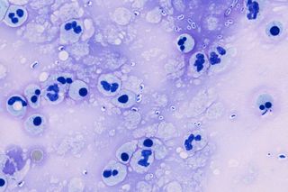infection anorexia bulimia