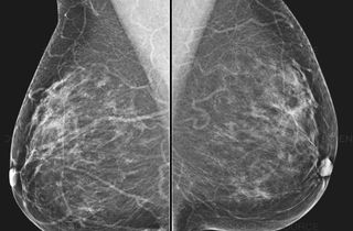 annual mammography