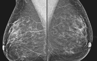 annual mammography