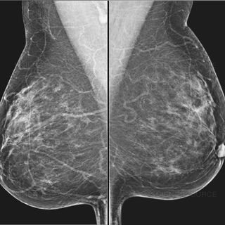 annual mammography