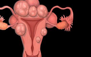 what are uterine fibroids