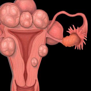 what are uterine fibroids