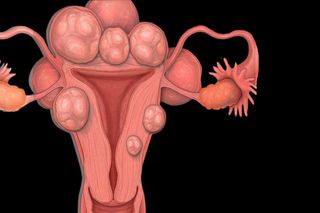 what are uterine fibroids