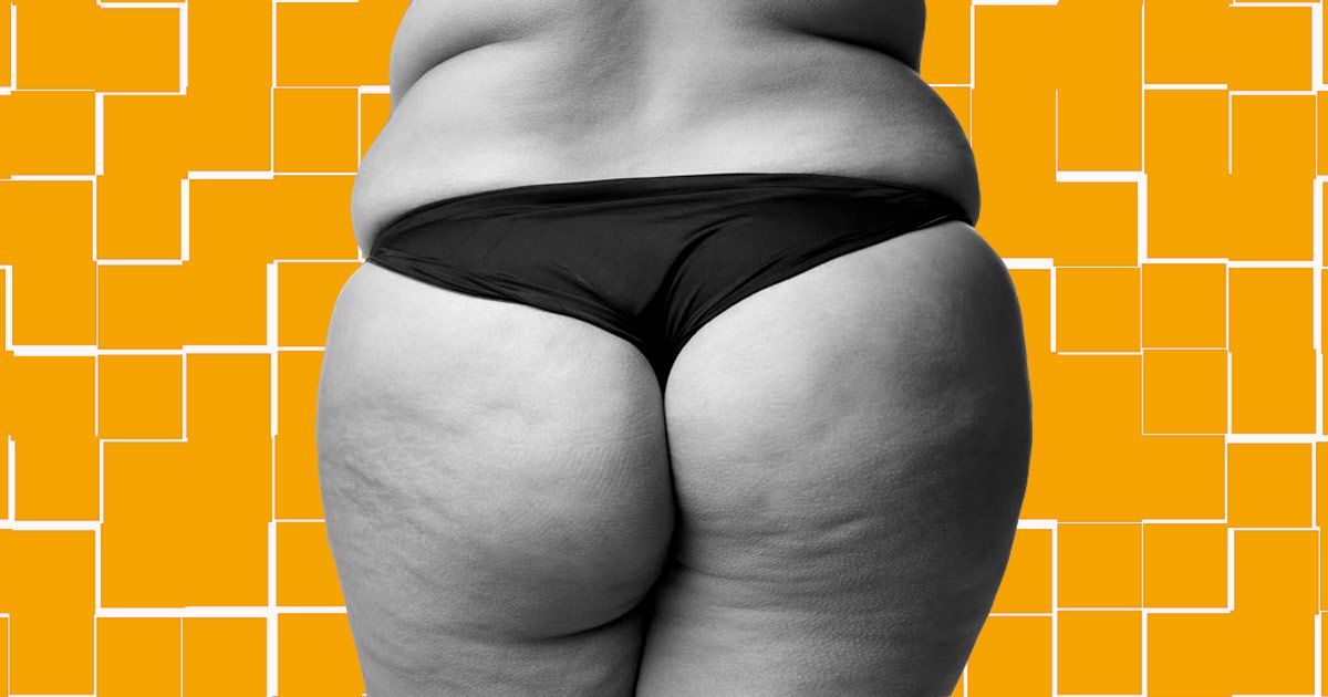 Cellulite 101: Causes, Myths, and Proven Solutions - MYSA
