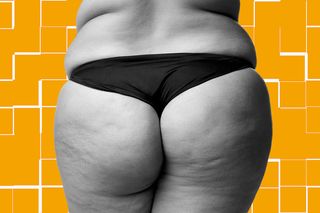 what is cellulite
