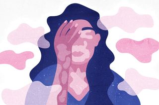 living with vitiligo