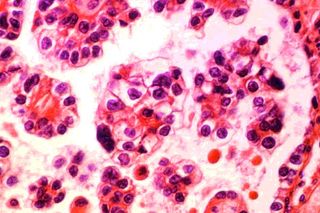 Minimally Invasive Surgeries For Early Stage Cervical Cancer Patients Pose A High Mortality Risk As Compared To Open Surgeries