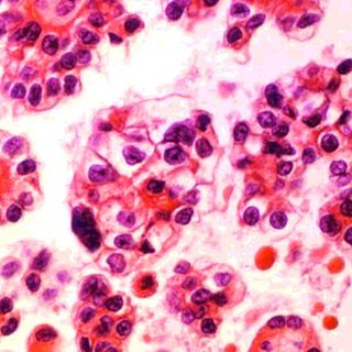 Minimally Invasive Surgeries For Early Stage Cervical Cancer Patients Pose A High Mortality Risk As Compared To Open Surgeries