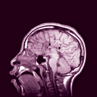 brain structure fetal alcohol spectrum disorder