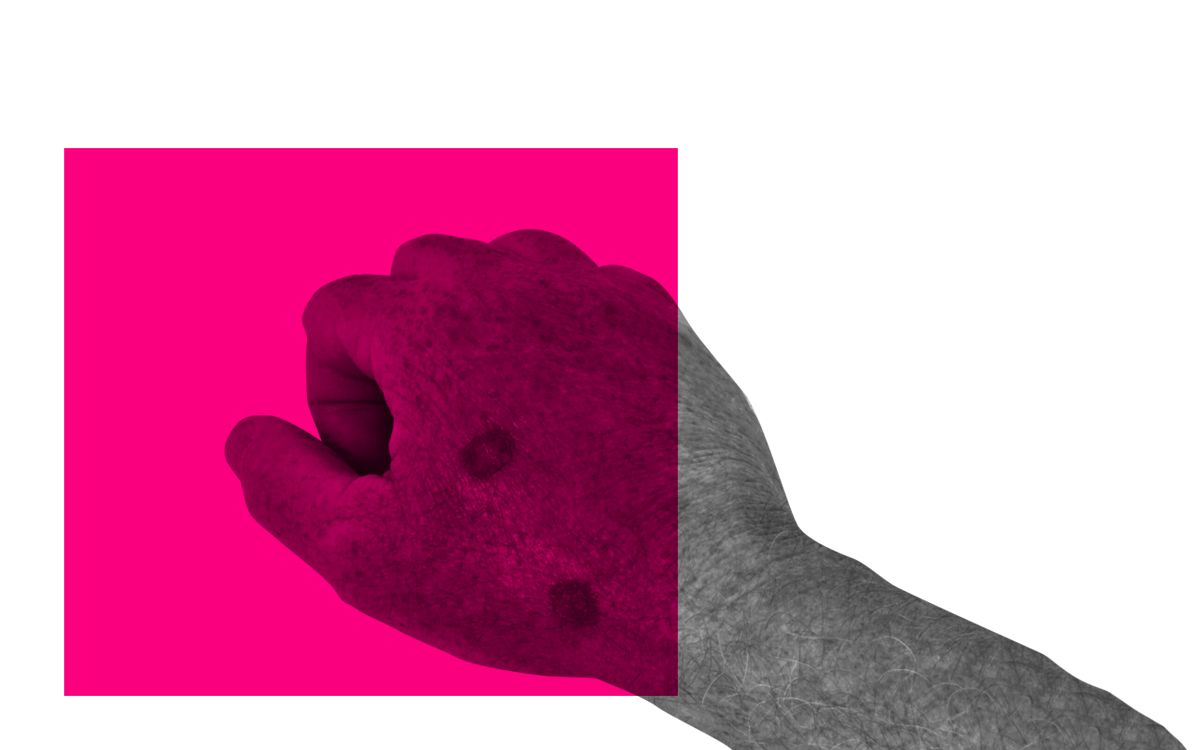 incidence of skin cancer in india