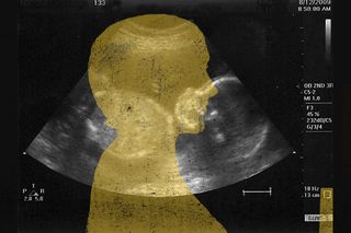abortion is not traumatic