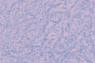 is NF1 genetic condition treatable