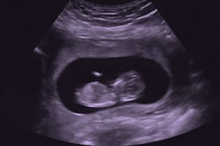 after miscarriage