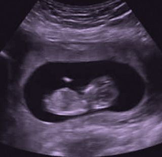 after miscarriage