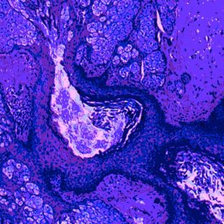 Do I Have To Worry If I Have A Simple Ovarian Cyst?