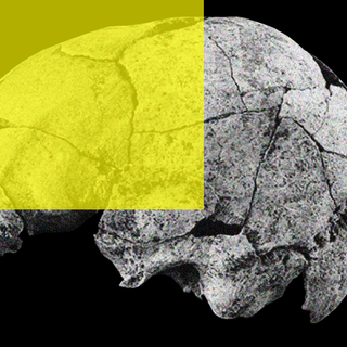 skull evidence of ear surgery