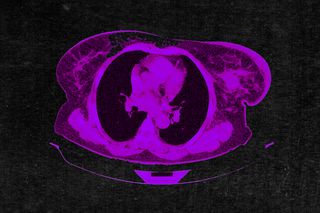 breast cancer drug