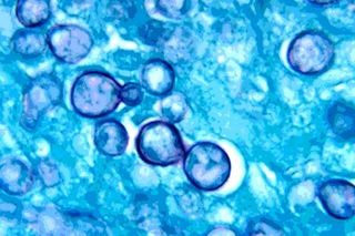 female reproductive tract infections
