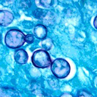 female reproductive tract infections