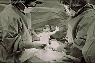 c-section rate in india