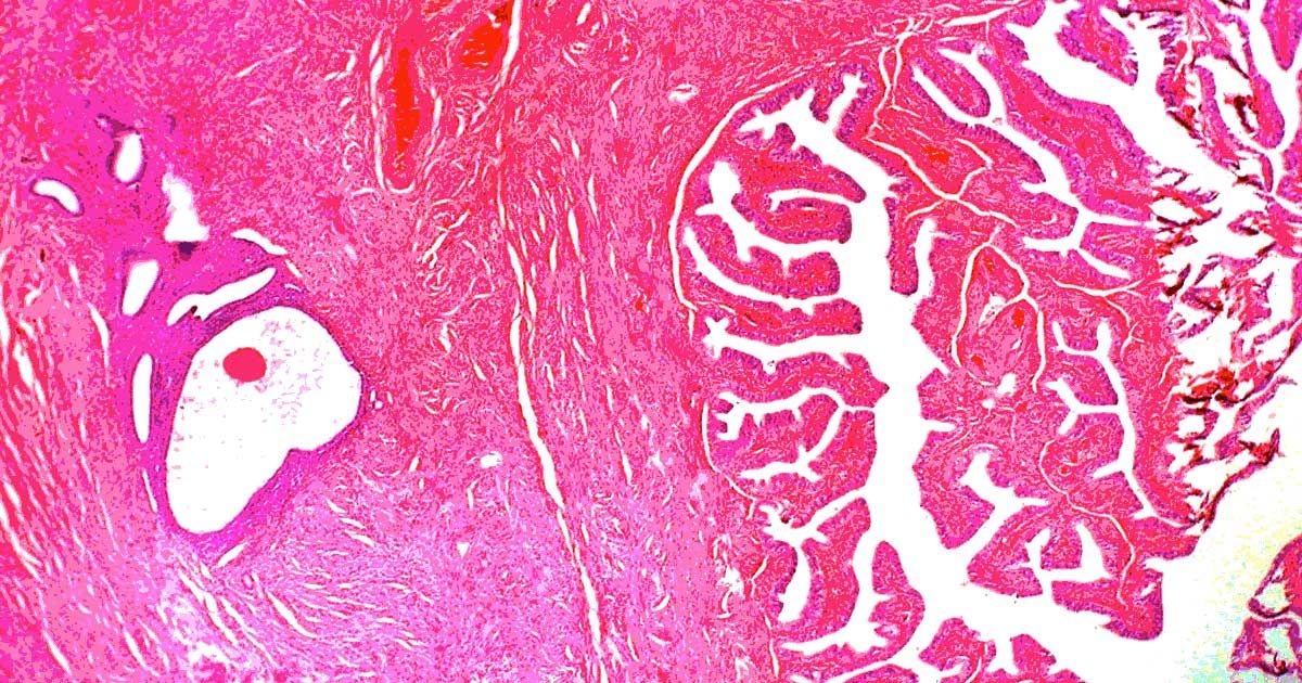 endometriosis hormone treatment