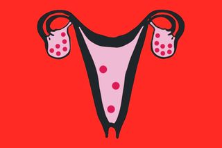PCOS and fatty liver