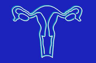pcos diagnosis