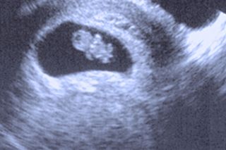 recurrent miscarriage treatment