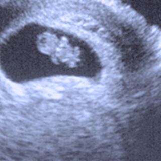 recurrent miscarriage treatment