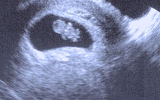 recurrent miscarriage treatment