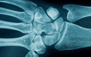 are women more likely to get carpal tunnel syndrome