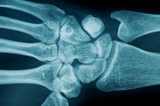 are women more likely to get carpal tunnel syndrome