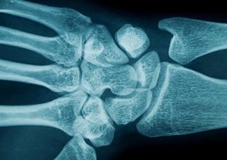 are women more likely to get carpal tunnel syndrome