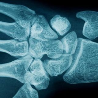 are women more likely to get carpal tunnel syndrome