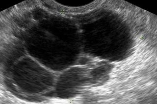 PCOS