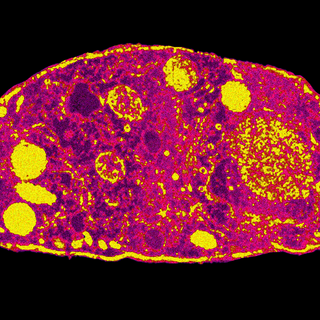 Toxoplasmosis