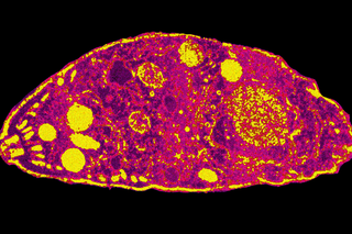 Toxoplasmosis