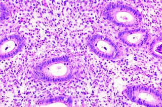 endometriosis and pregnancy