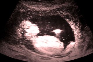 why does stillbirth happen