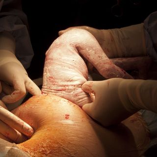 c-sections lead to lower rate of conception