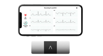KardiaMobile 6L -laitteen kuusikanavainen EKG-tallenne älypuhelimen näytöllä