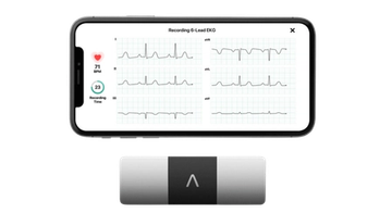 KardiaMobile 6L -laitteen kuusikanavainen EKG-tallenne älypuhelimen näytöllä