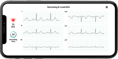 KardiaMobile 6L -laitteen kuusikanavainen EKG-tallenne älypuhelimen näytöllä