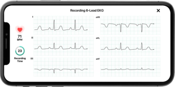 KardiaMobile 6L -laitteen kuusikanavainen EKG-tallenne älypuhelimen näytöllä