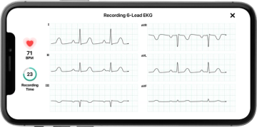 KardiaMobile 6L -laitteen kuusikanavainen EKG-tallenne älypuhelimen näytöllä