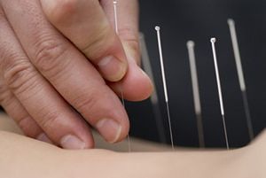 Functional Acupuncture vs. Community Acupuncture