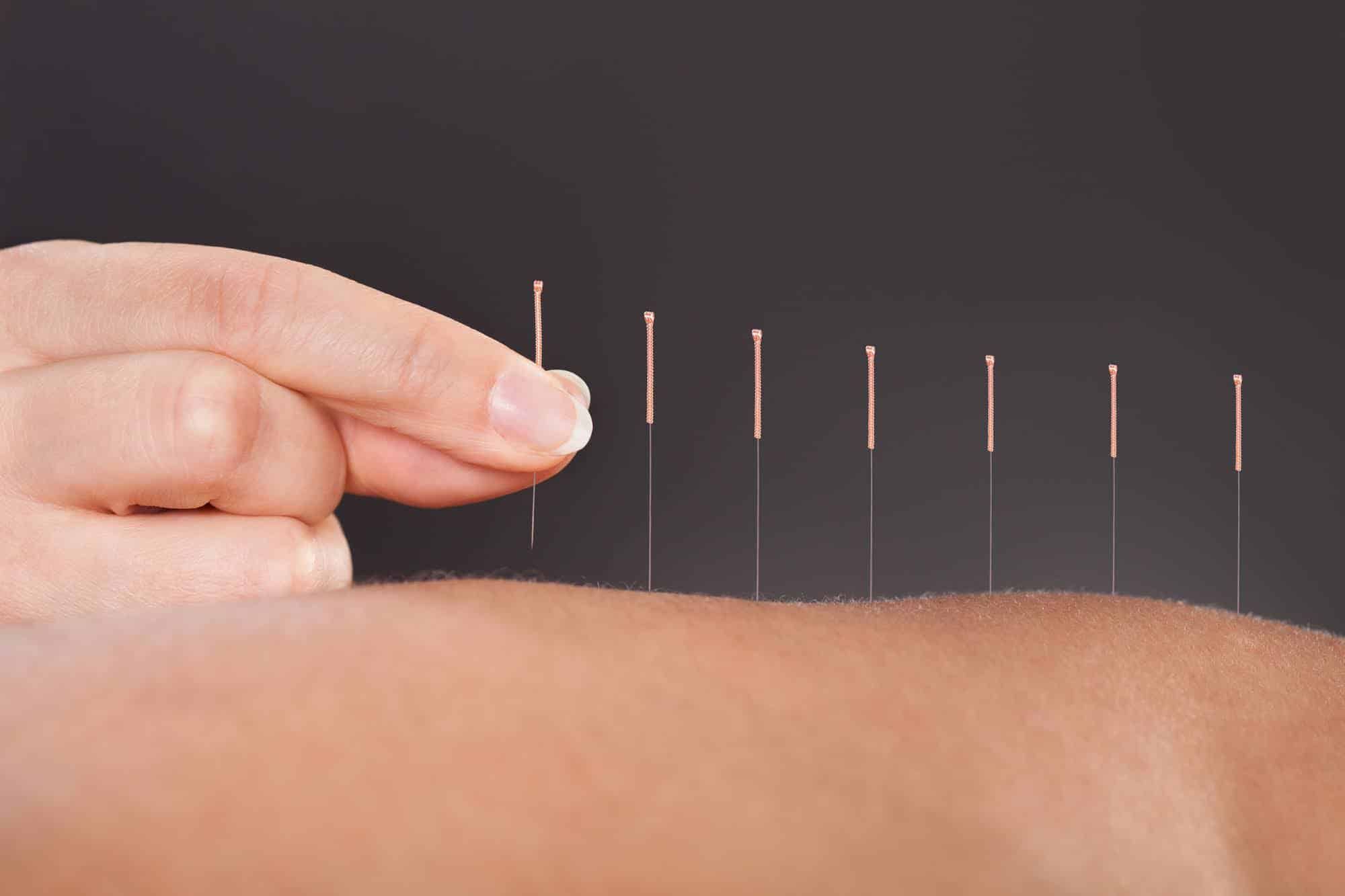 New to Acupuncture? 5 Commonly Asked Questions