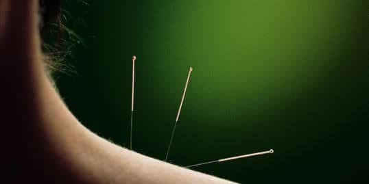 Everything You Need to Know About Using Acupuncture for Pain Management