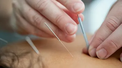 An image of a person receiving acupuncture for low back pain.