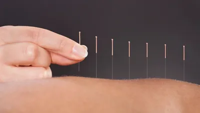 What Is Acupuncture and How Does It Work? How Inserting Tiny Needles Can Relieve Pain, Reduce Stress, and Improve Overall Health in Milwaukee, Wisconsin